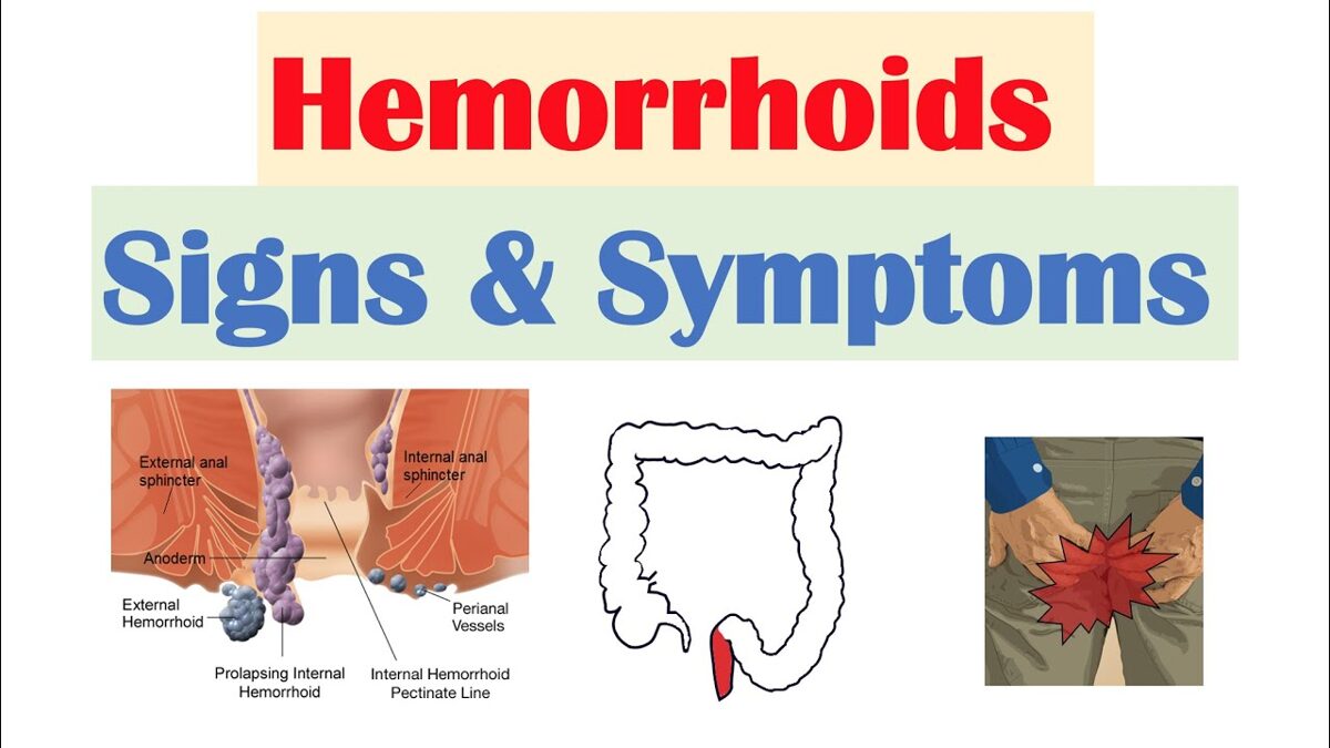 Just How Are Hemorrhoids Detected Blog My Gorgeous Web blog